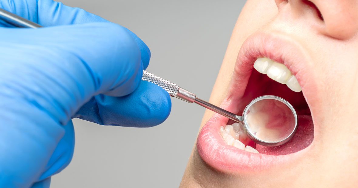 parodontite chronique